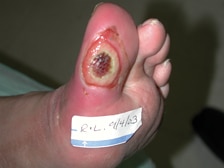 Infekcija ulkusa stopala